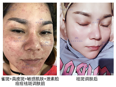 祛斑案例-美膚來（深圳）生物科技有限公司