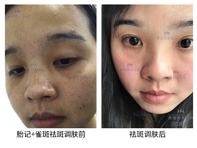 祛斑案例-美膚來（深圳）生物科技有限公司