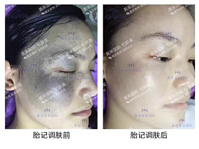 胎記技術(shù)調(diào)膚案例-美膚來（深圳）生物科技有限公司