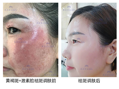 祛斑案例-美膚來（深圳）生物科技有限公司
