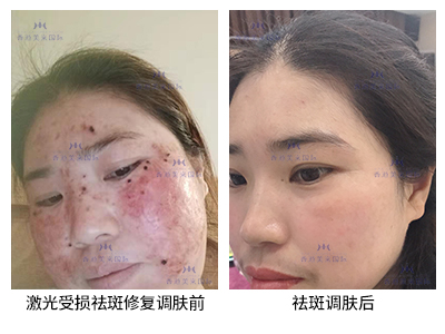 祛斑案例-美膚來（深圳）生物科技有限公司
