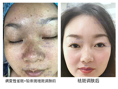 祛斑案例-美膚來（深圳）生物科技有限公司