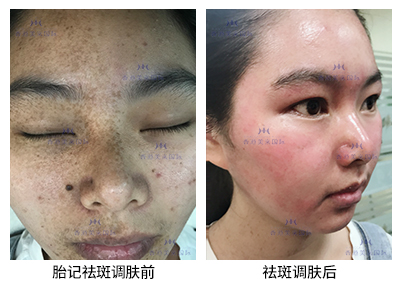 祛斑案例-美膚來（深圳）生物科技有限公司