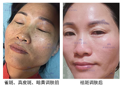 祛斑案例-美膚來（深圳）生物科技有限公司