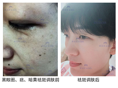 祛斑案例-美膚來（深圳）生物科技有限公司