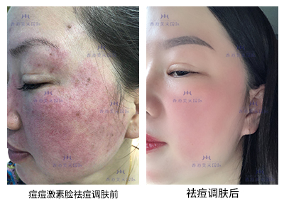 祛痘案例-美膚來（深圳）生物科技有限公司