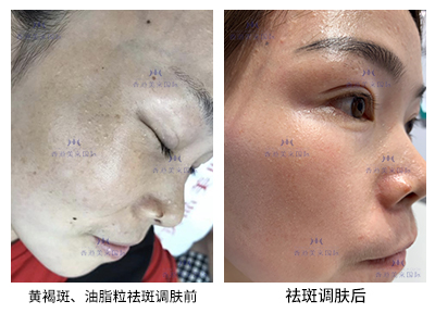 祛斑案例-美膚來（深圳）生物科技有限公司