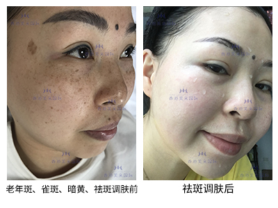 祛斑案例-美膚來（深圳）生物科技有限公司