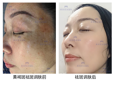 祛斑案例-美膚來（深圳）生物科技有限公司