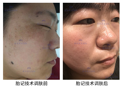 胎記技術(shù)調(diào)膚案例-美膚來（深圳）生物科技有限公司